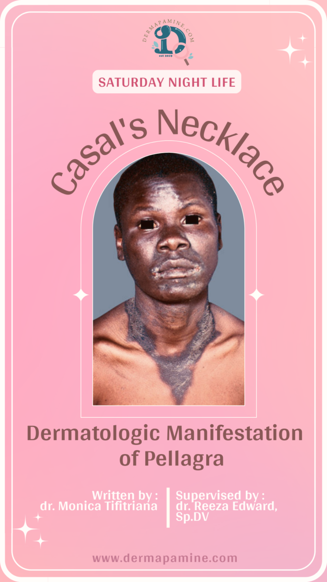 Casal’s Necklace Dermatologic Manifestation of Pellagra — DERMAPAMINE